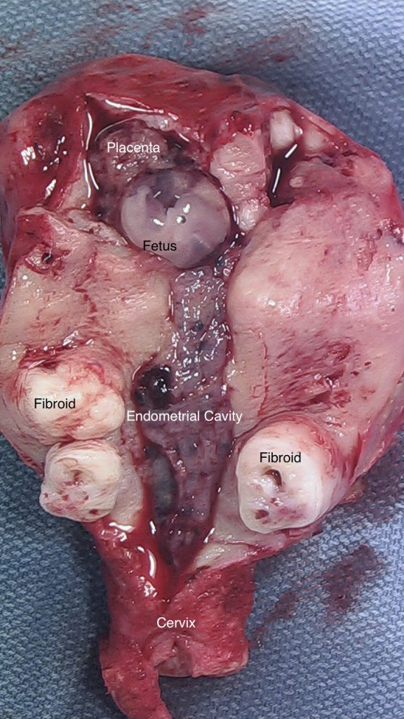 Uterus Removed with Ectopic Pregnancy seen on the Right Corner. Fibroids also visible. 
