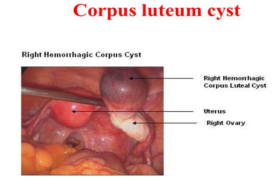 Ovarian Cysts - Dr. Elena Rodriguez
